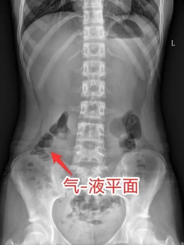 连吐10余次，12岁男孩除夕当天被紧急送医！