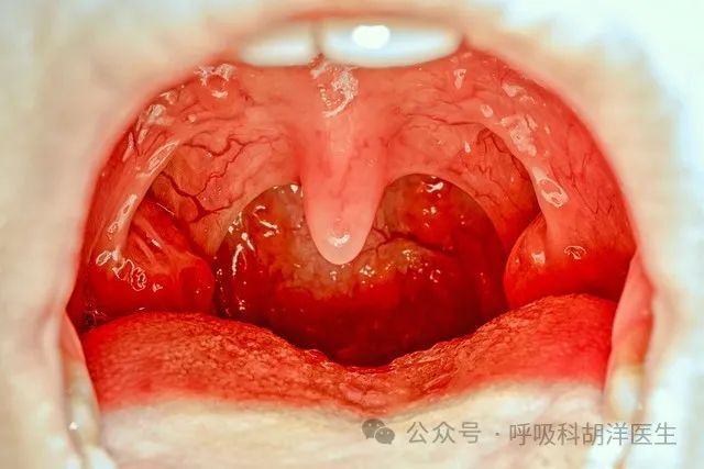 肺的免疫能力来自于哪里，从一个细菌的视角来看肺部免疫系统