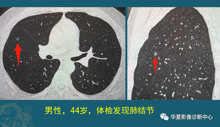 从1个小结节，发展成肺癌，需要几年？