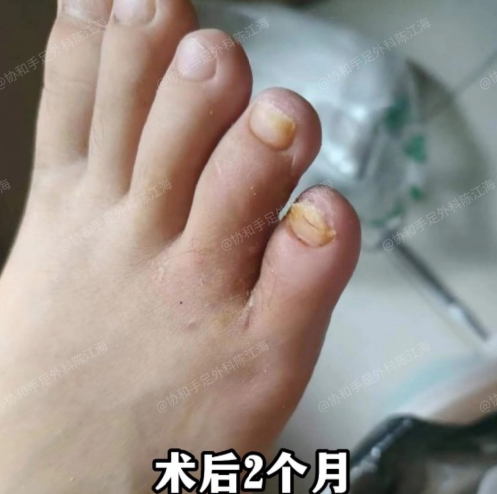 孩子多趾并趾，爸爸妈妈常关心这2个问题