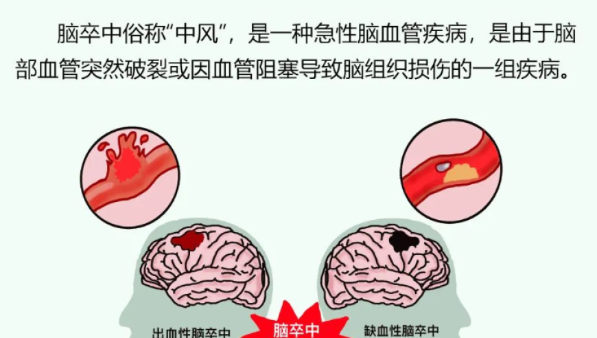 脑卒中急救指南：快速处理方法，一看就懂！