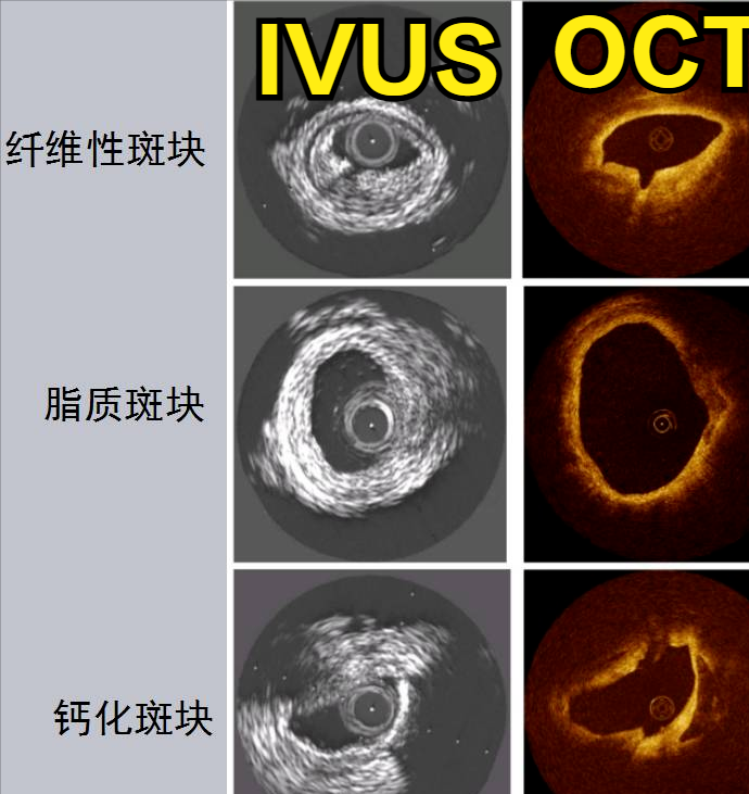 冠脉造影有狭窄，斑块是否稳定咋判断？距离急性心梗到底有多远？