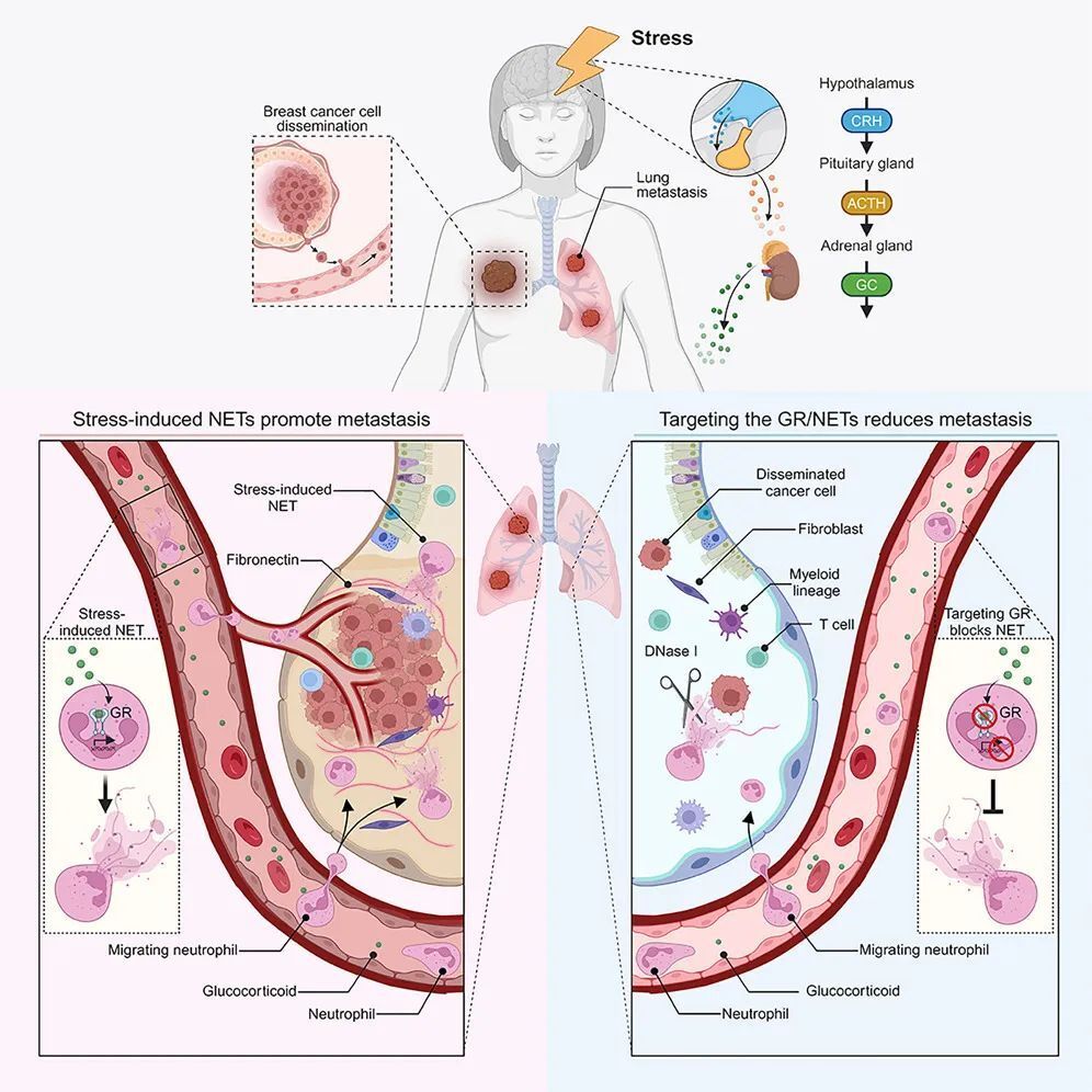 Cancer Cell：何雪妍等人揭示慢性压力是如何促进癌症转移的