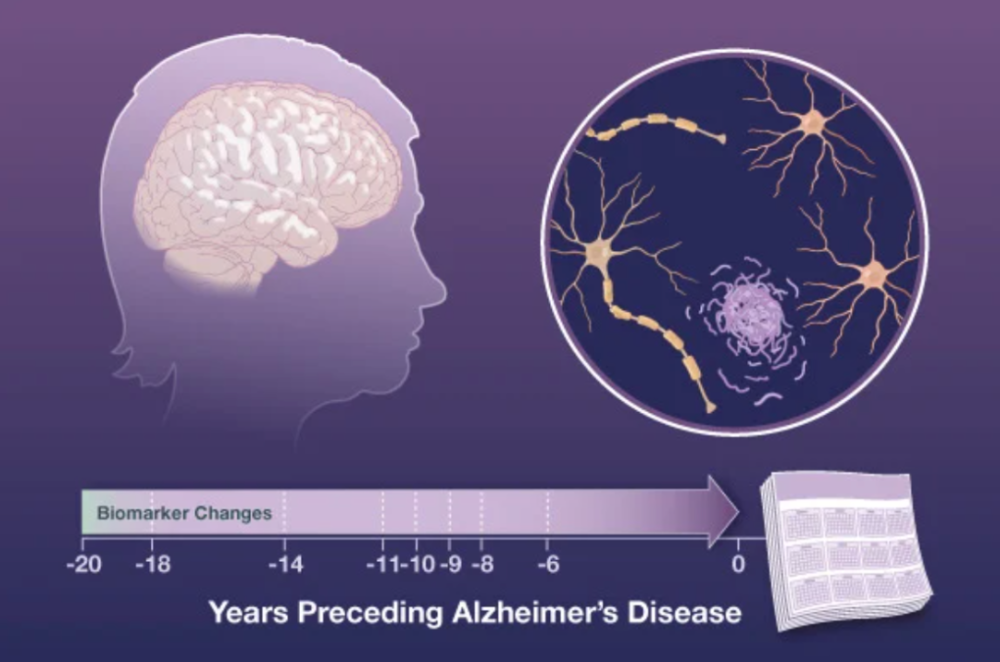 贾建平团队发表NEJM论文，提前18年发现阿尔茨海默病异常生物标志物