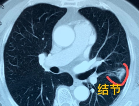 一查出肺结节就慌了，每个月都跑去做CT、想手术？我想先拦住您