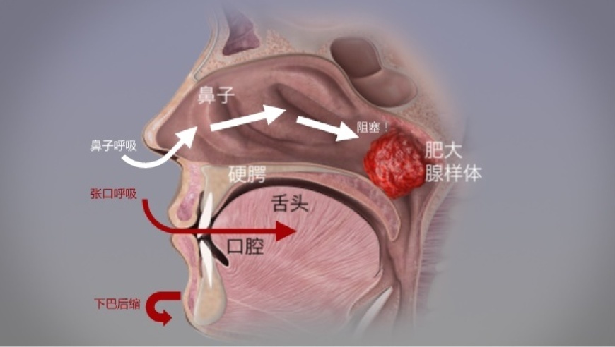 张口呼吸会变丑？闭嘴贴真有效吗？