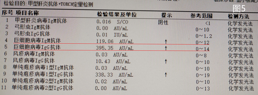 短短20天，这名幼儿的血小板数值减少了100倍？——记一例巨细胞病毒感染导致的婴幼儿急性免疫性血小板减少性紫癜