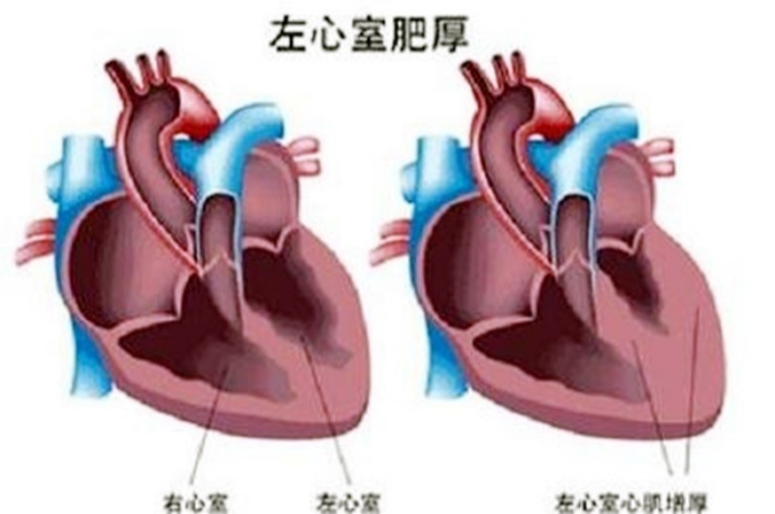 心电图发现“左心室高电压”是心脏病吗？测个血压，发现问题了