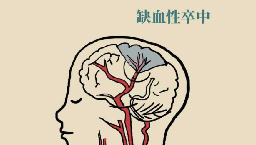 中风后医生开了两种抗血小板药，会引发大出血吗？