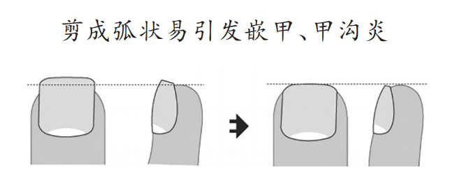 剪指甲时去掉的那块“死皮”，其实一直在保护你