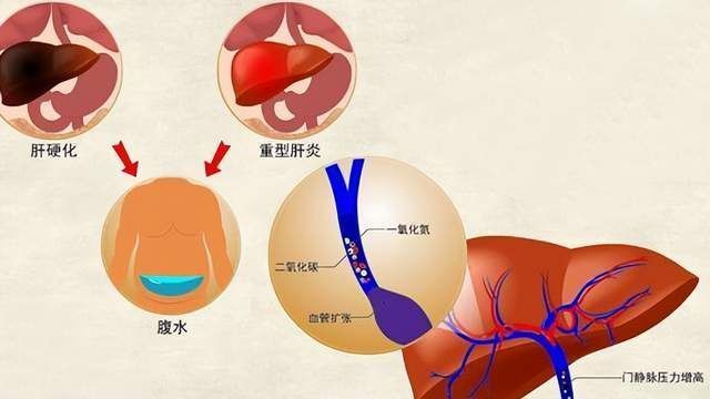 什么是肝硬化“再代偿”？