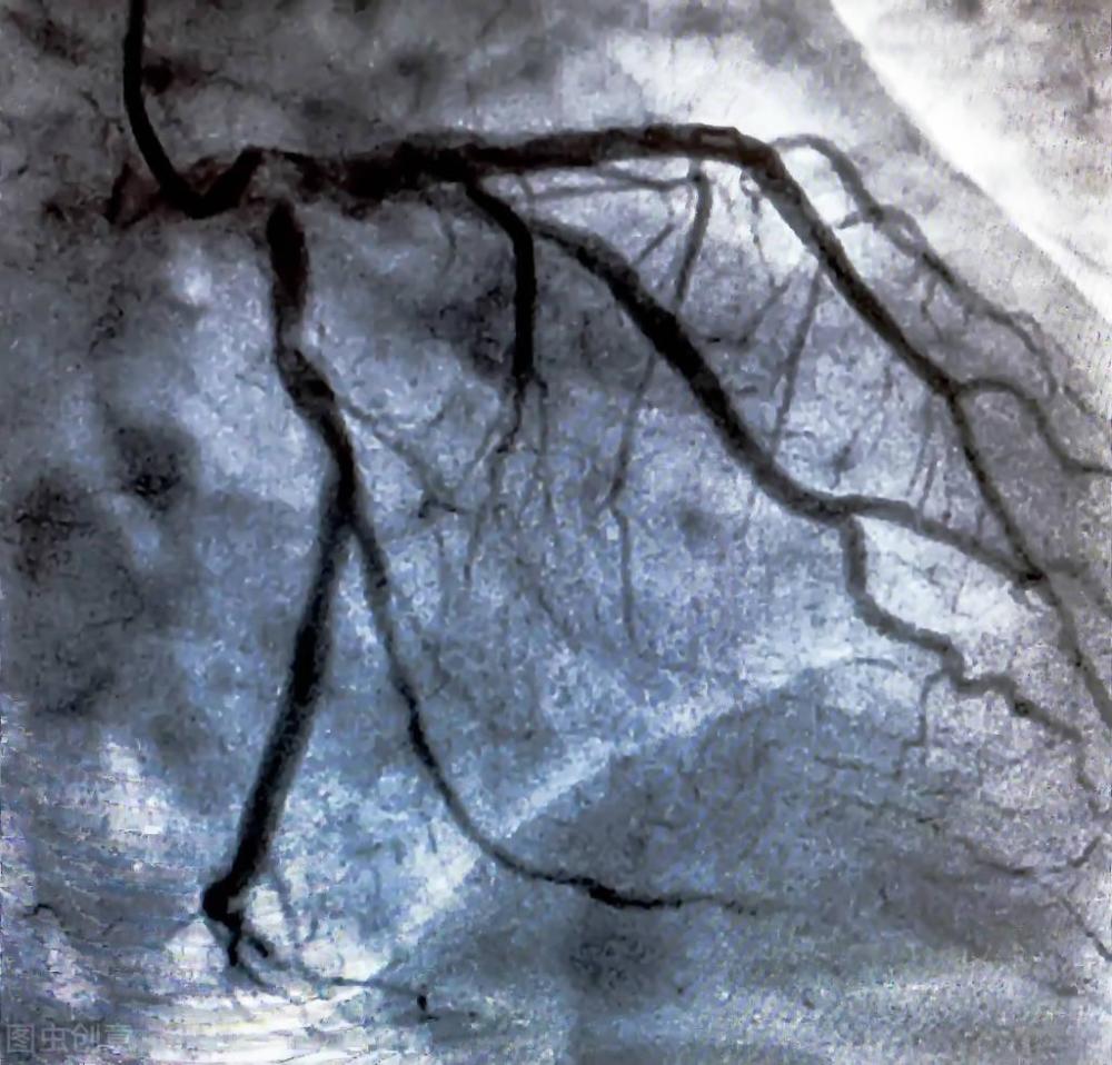 怀疑冠心病，听别人说做冠脉CT，医生却建议做冠脉造影，为什么？