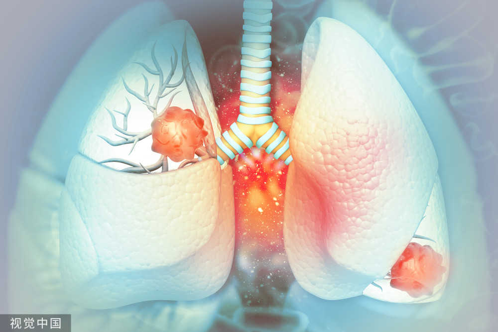 考虑良性的肺结节，随访期间还会变恶性？莫慌！告诉你实情