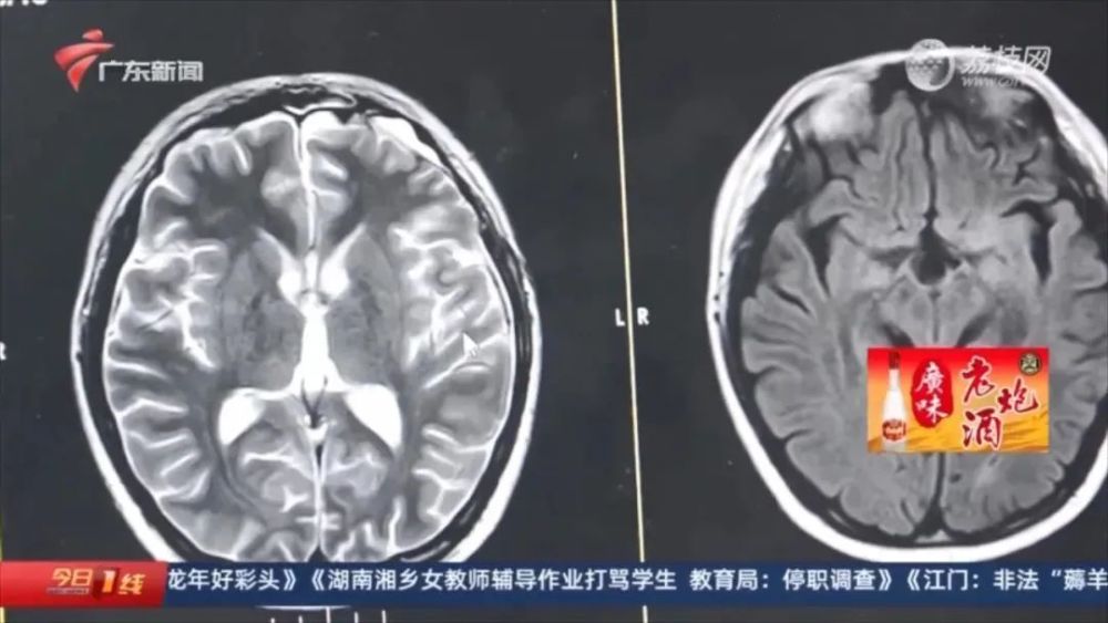 16岁男孩得“怪病”，每天狂喝9升水