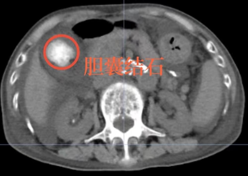 九旬太婆结石腹痛轻信偏方，不仅无效还损伤肝脏险丢性命