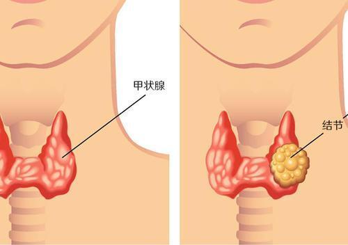 甲状腺结节？不要慌！科学应对！8个方法，保护你的甲状腺健康