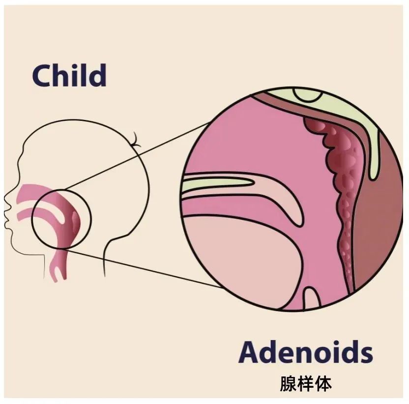 为什么现在患腺样体肥大的孩子越来越多?