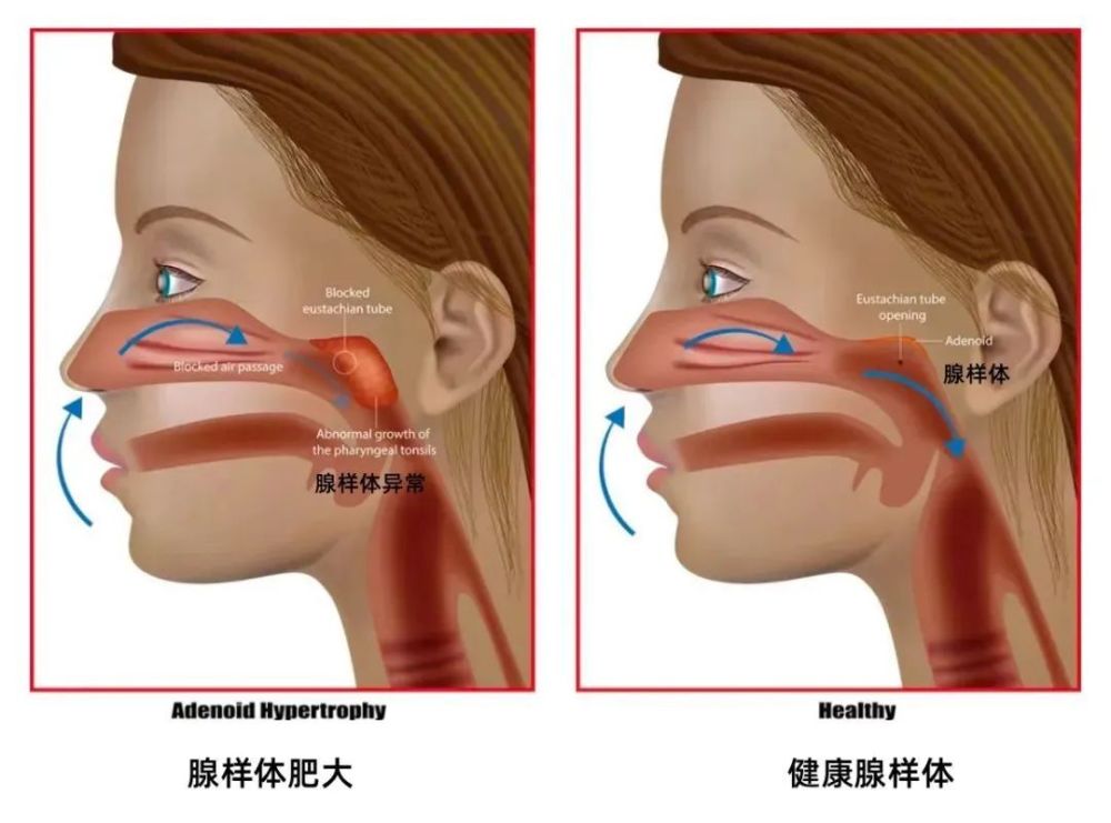 为什么现在患腺样体肥大的孩子越来越多?