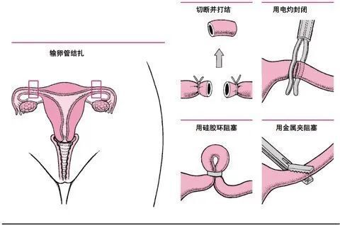 41岁男子去医院做胆囊手术却被意外结扎：“我还想生娃怎么办啊？”