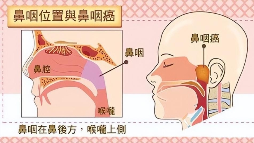 鼻窦癌知多少？潜伏、预防有妙招，五大误区要避免！