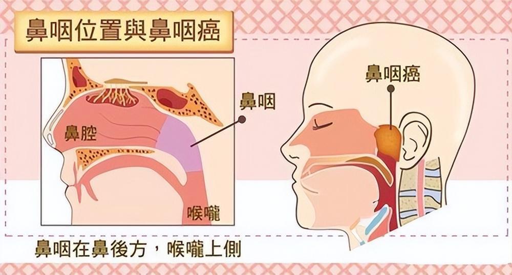 鼻窦癌怎么回事？怎样潜伏起来的？如何早期预防？五大误解不要犯