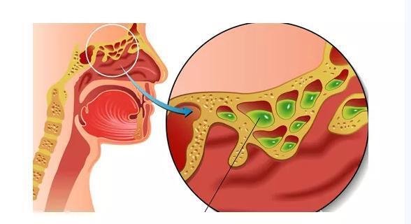 鼻窦癌怎么回事？怎样潜伏起来的？如何早期预防？五大误解不要犯