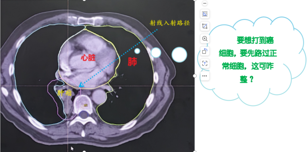 看不见的​“射线”是怎么清除癌细胞的？是时候真正认识一下放疗了！