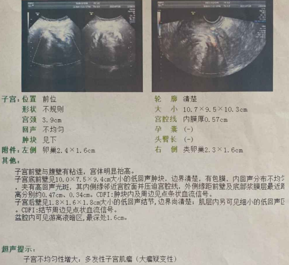 【真实案例】子宫肌瘤10公分，HPV感染两年，有没有不切子宫的治疗方法？