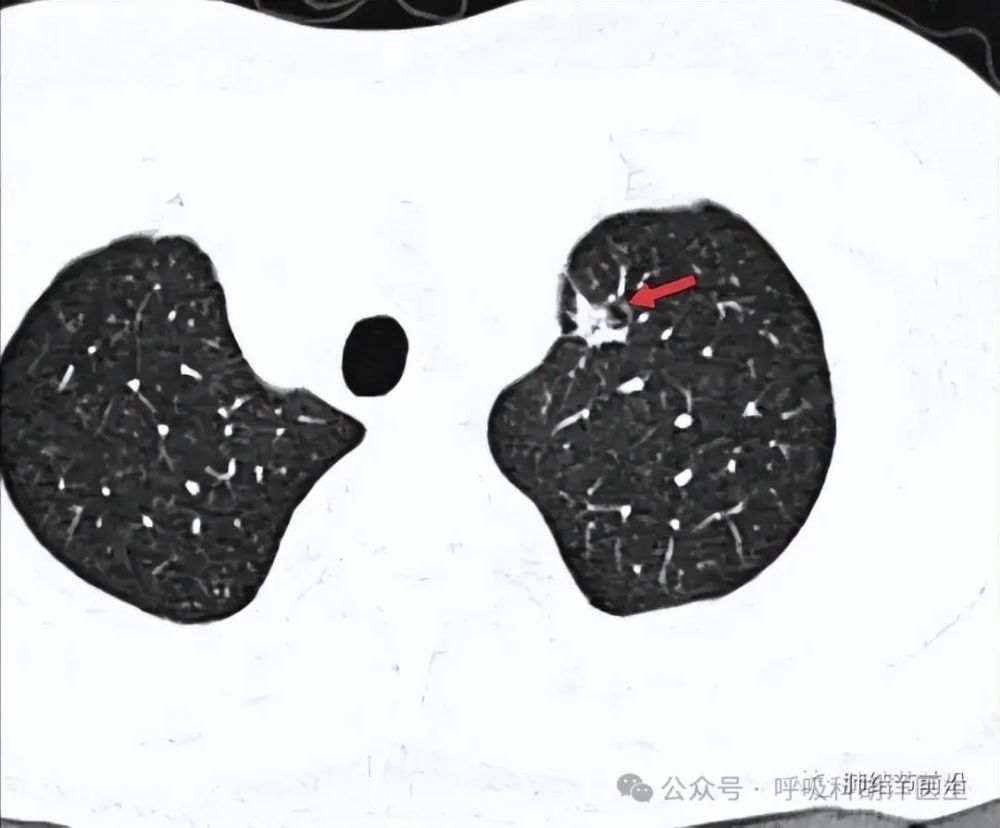 肺部结节长空泡不是好事，如果出现增大表现，一定要早做处理