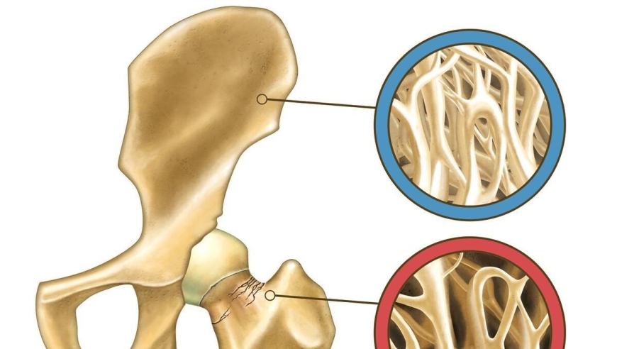 六类人群易患骨质疏松，五大危害须知！