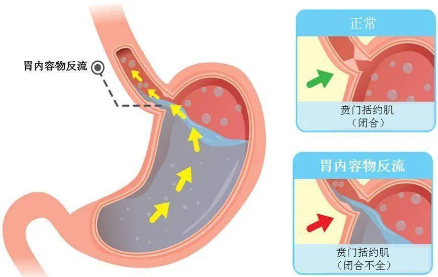 想让孩子咳嗽好得快，家长要分清是干咳还是湿咳，才能对症用药