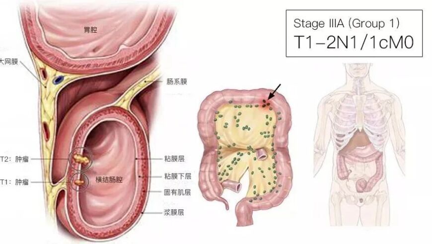 一文读懂：结直肠癌TNM分期，通俗易懂的解析！