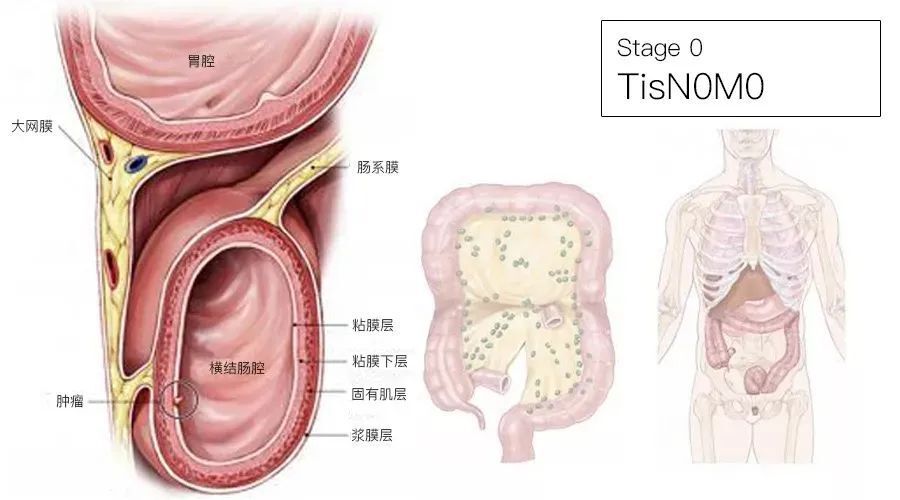 一文了解：结直肠癌TNM分期