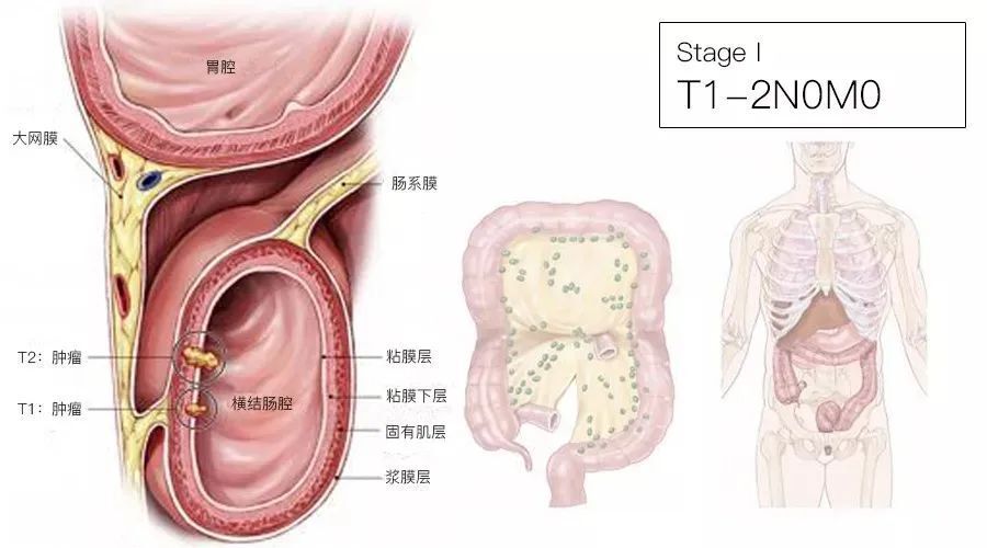 一文了解：结直肠癌TNM分期