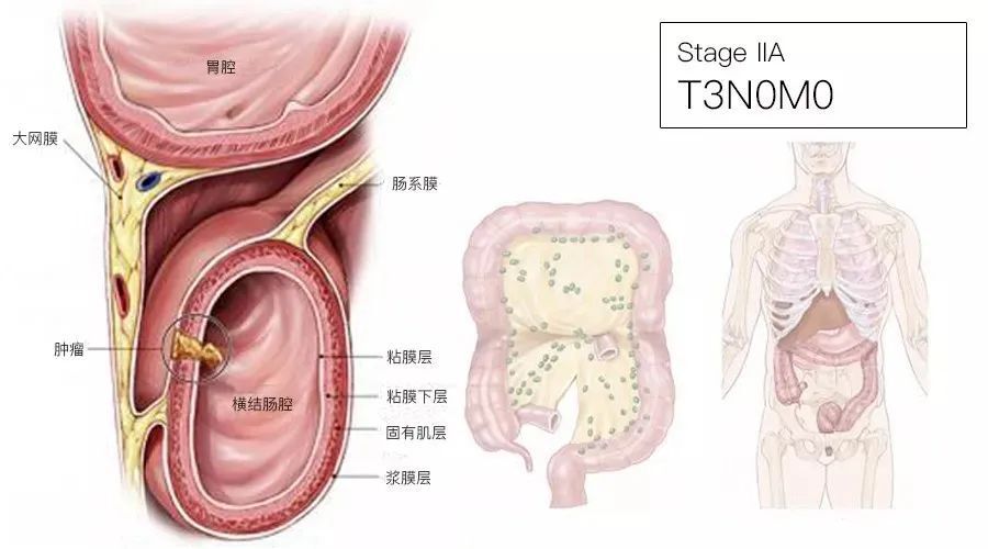 一文了解：结直肠癌TNM分期