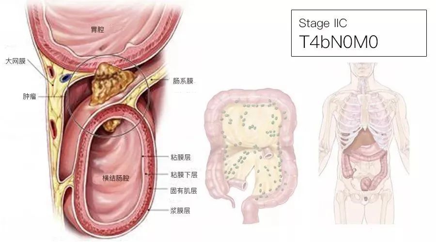 一文了解：结直肠癌TNM分期