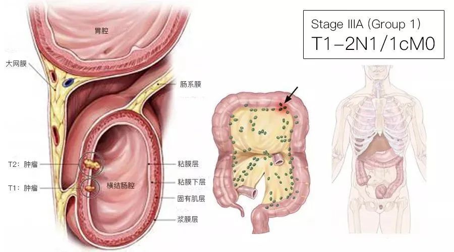 一文了解：结直肠癌TNM分期