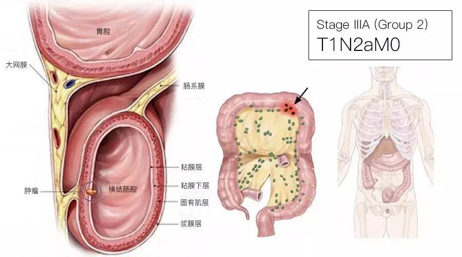 一文了解：结直肠癌TNM分期