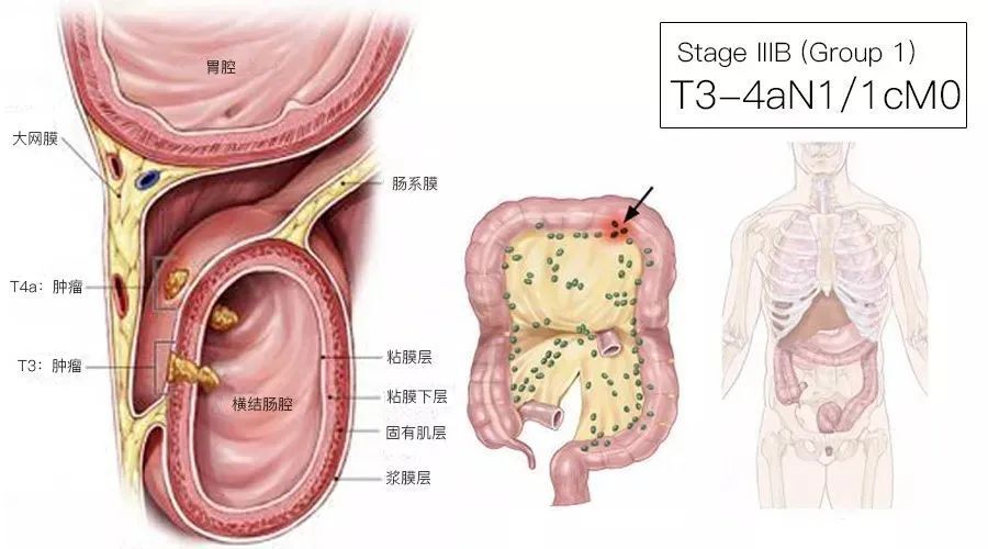 一文了解：结直肠癌TNM分期