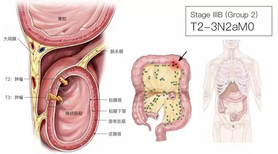 一文了解：结直肠癌TNM分期