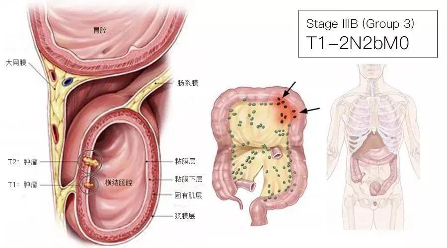 一文了解：结直肠癌TNM分期