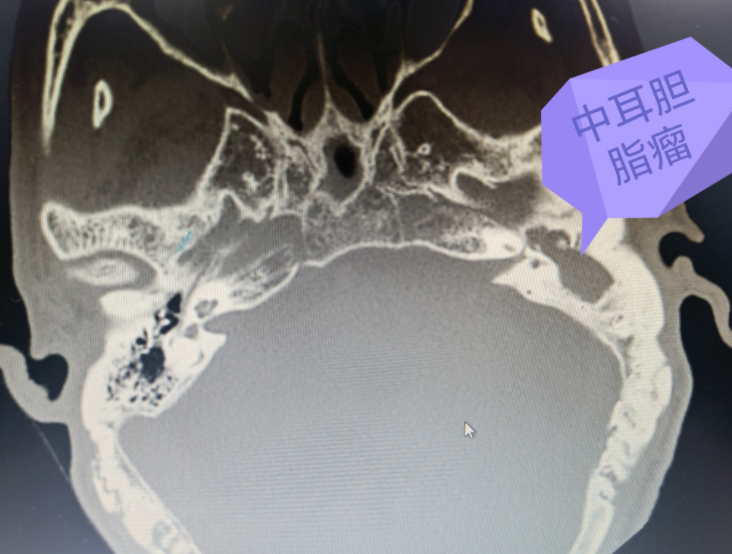 宁德男子突然发烧、颅内感染险丧命！医生曝光病因，为很多人敲响警钟