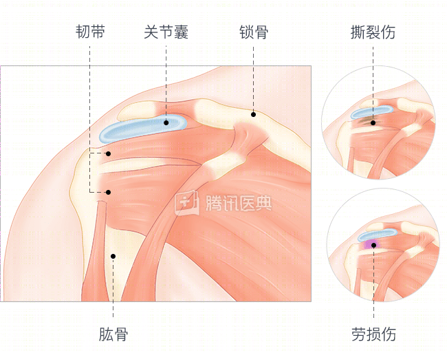 肩膀痛就是肩周炎吗？其实大部分不是，而是这个病！