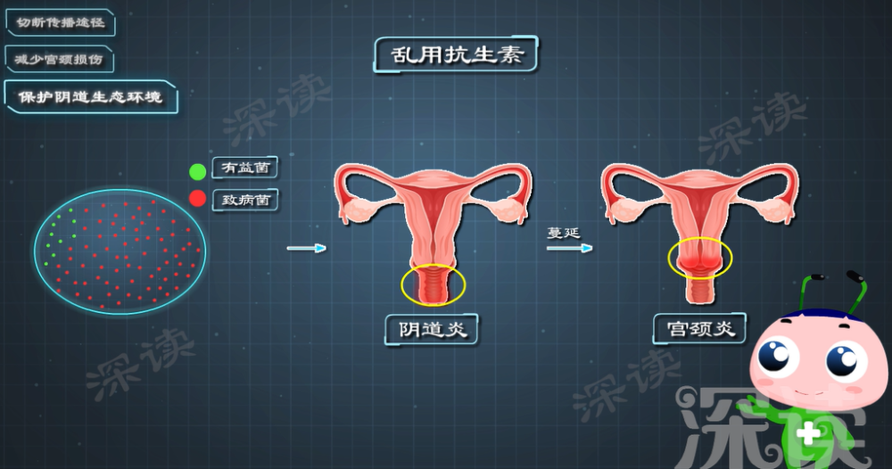 宫颈炎是因私生活乱？洗洗真的更健康？躲开宫颈炎就得做好这4点