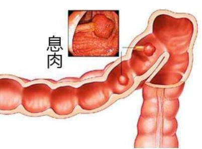 胃肠息肉与胃肠溃疡：守护你的“胃”来“肠”往