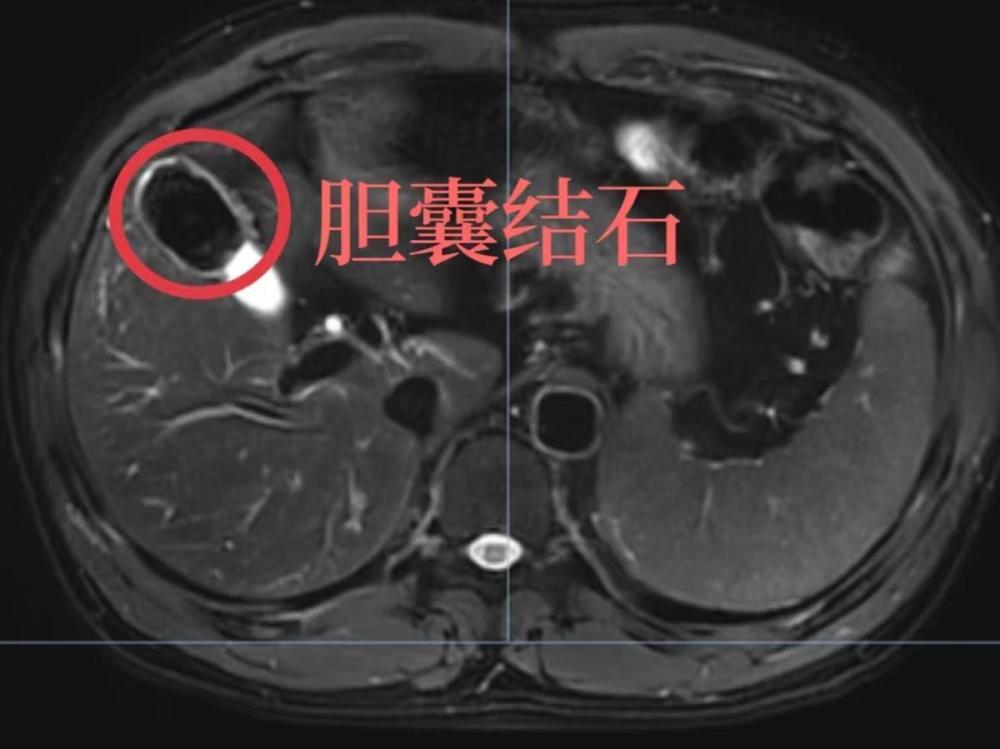 兄弟仨接连被胆囊结石“盯上”，医生提醒：胆囊结石具有一定的家族聚集性