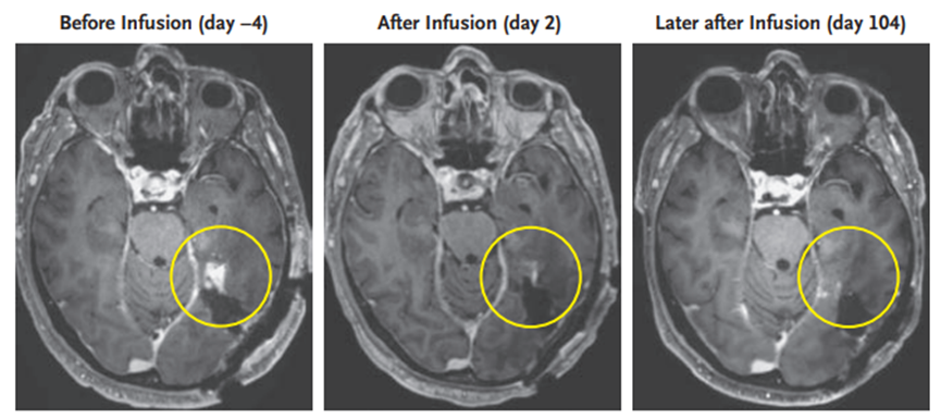 5天就让恶性脑瘤几乎完全消失？CAR-T疗法登上《新英格兰医学杂志》
