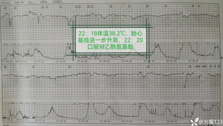 产妇发热，胎心变异别忽视，关键信息要牢记！