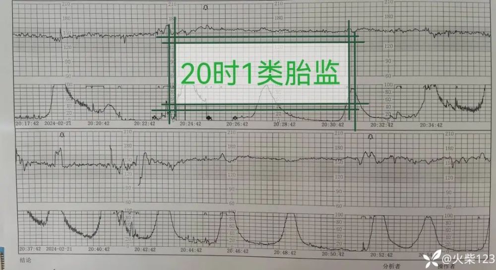 产妇发热，胎心基线变异，千万别忽略这个关键因素！