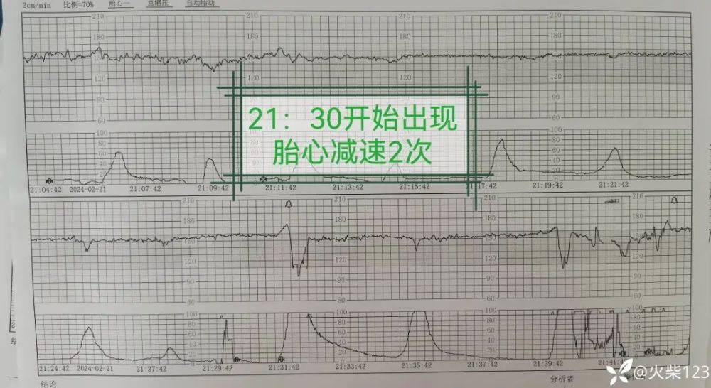 产妇发热，胎心基线变异，千万别忽略这个关键因素！